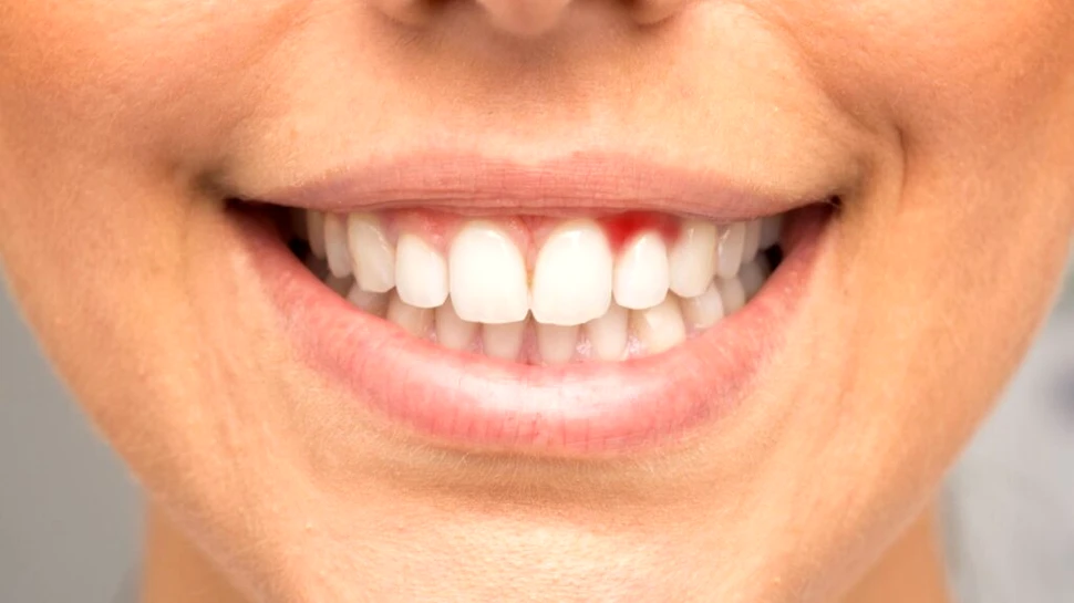 Sângerarea gingiilor ar putea fi un semn precoce al unei afecțiuni mult mai grave