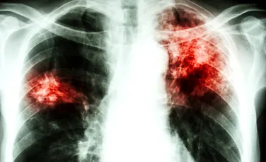 Tuberculoza, diagnosticată în doar două ore în Bucureşti şi Bisericani-Neamţ. Până acum dura 4-6 luni