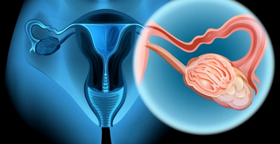 Chisturile ovariene ar trebui ”observate”, nu îndepărtate chirurgical