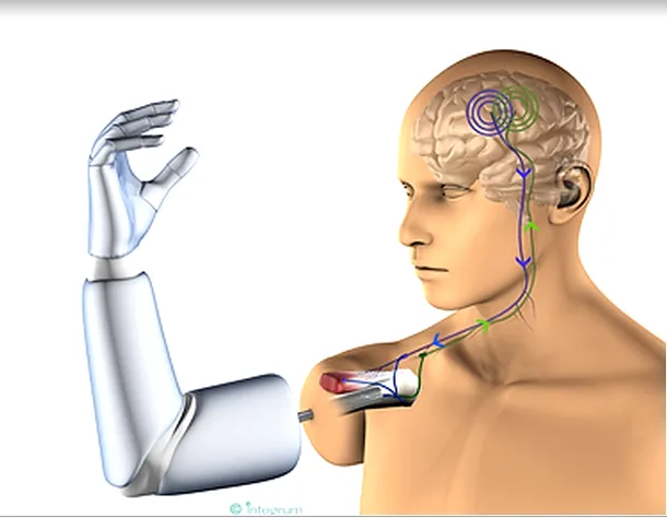 Fuziunea om-maşină: proteze implantate direct pe os