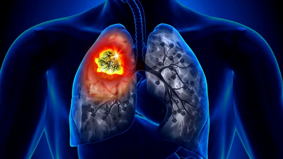 Un tip de vitamine utilizate frecvent poate creşte riscul apariţiei cancerului pulmonar