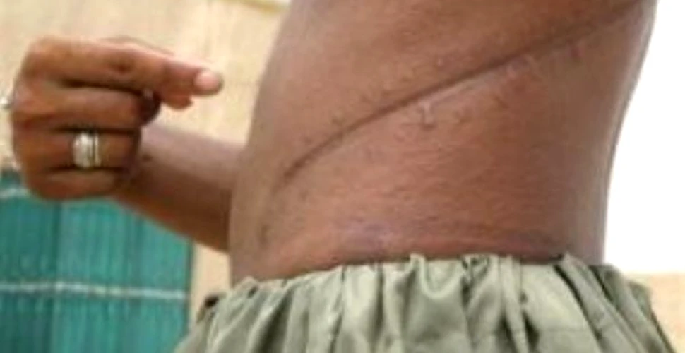 Omul cu 5 rinichi traieste in India