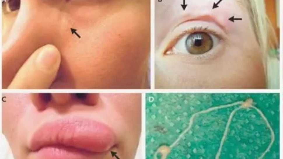 Medicii au fost intrigaţi de un caz medical înfiorător în care o umflatură bizară ”umbla” pe faţa unei femei