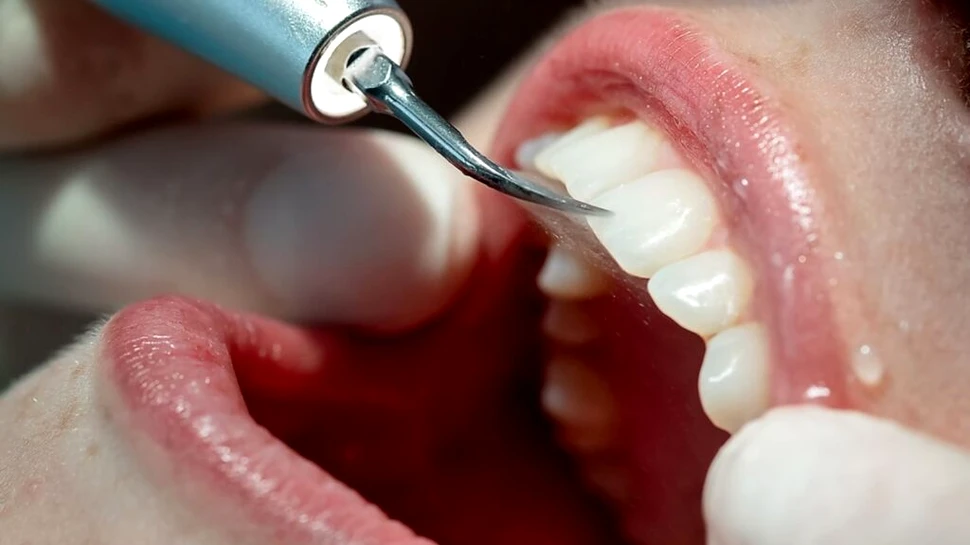 De ce este important detartrajul regulat pentru prevenirea afecțiunilor gingivale (P)
