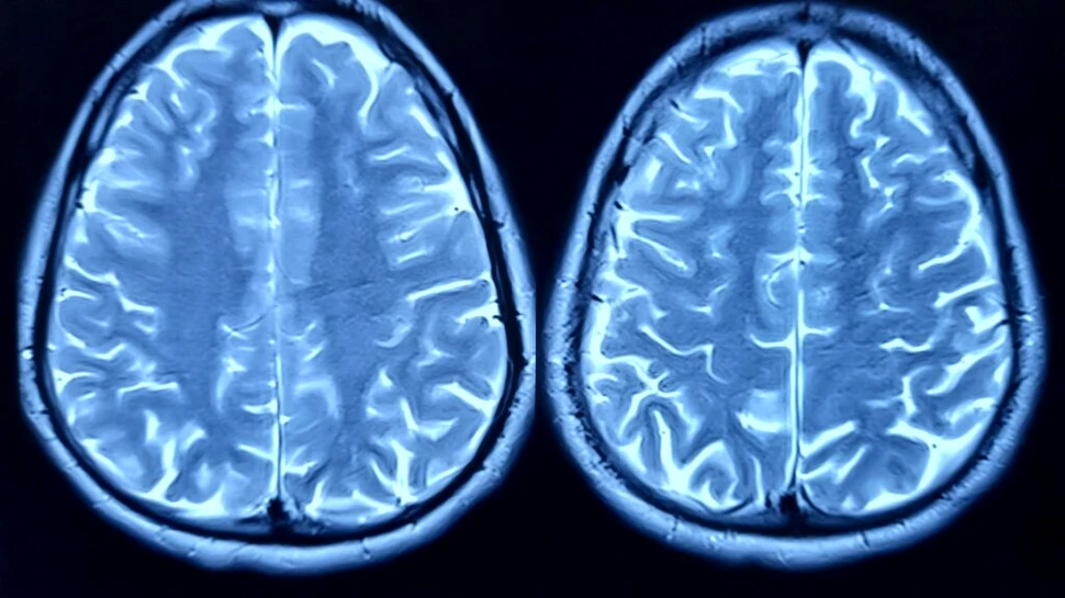 Depresia ar putea afecta capacitatea creierului de a genera noi neuroni
