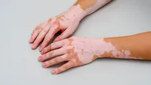 Un medicament pentru persoanele cu vitiligo a avut rezultate promițătoare într-un studiu clinic