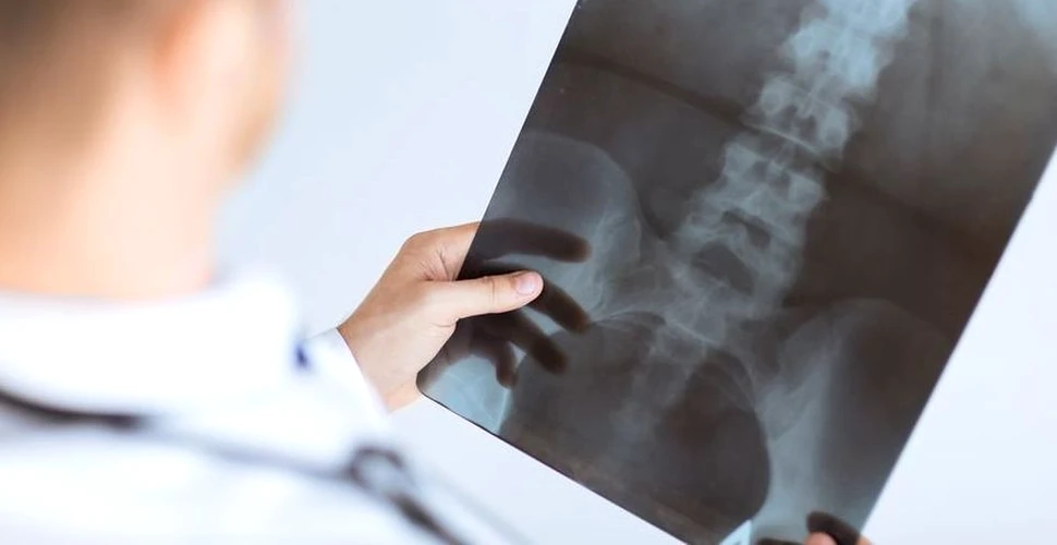 O radiografie incredibilă a dezvăluit o cană blocată în bazinul unui bărbat