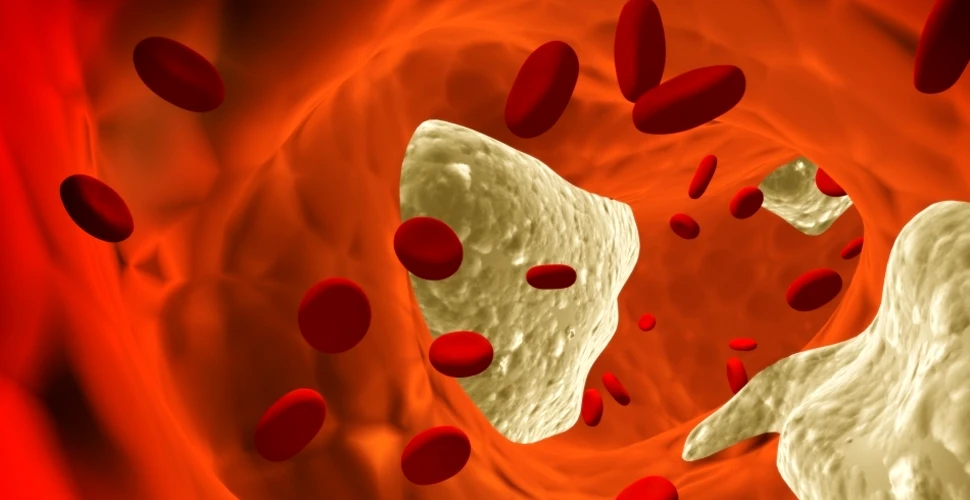 O pastilă cu „detergent” ar putea curăţa colesterolul de pe artere