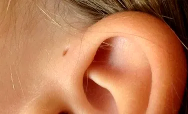 De ce unii oameni au o mică gaură deasupra urechii?