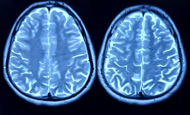 Oamenii de știință au descoperit ce accelerează îmbătrânirea creierului