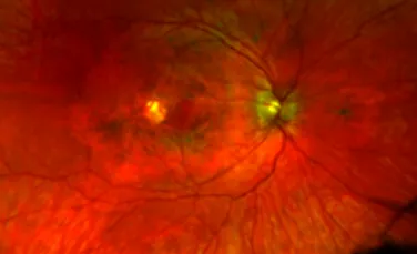 O nouă boală oculară genetică a fost descoperită. Cum se manifestă?