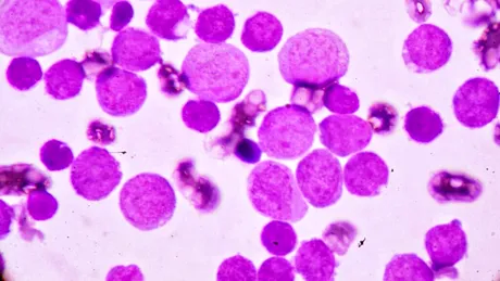 Cazurile de cancer în rândul celor de sub 50 de ani, problemă tot mai îngrijorătoare