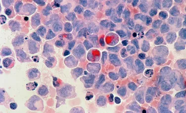 Noi compuși care distrug leucemia, descoperiți de cercetători