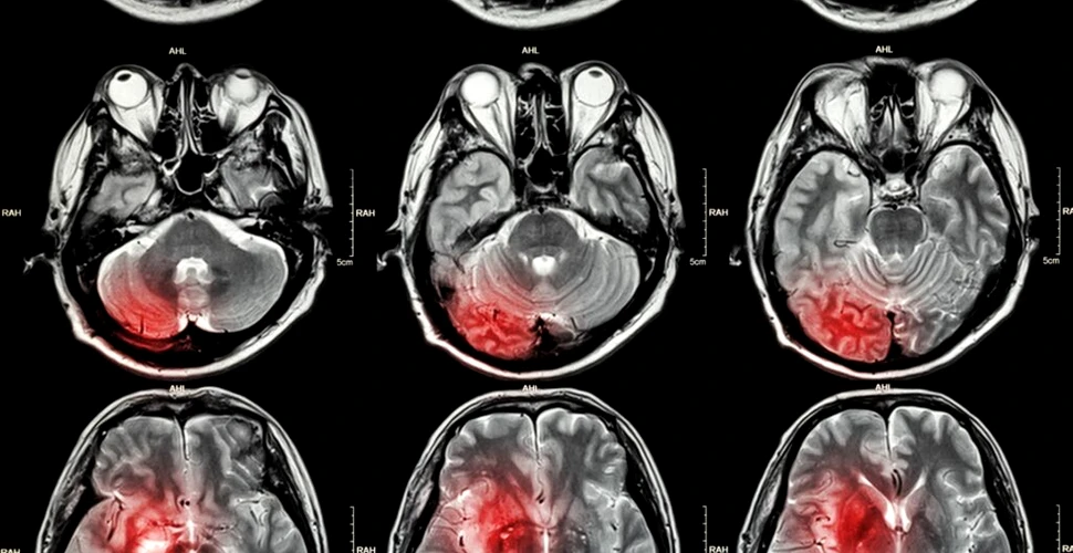 Pierderea ambelor ovare ar putea avea efecte negative pentru creier