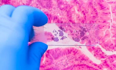 Cercetătorii canadieni anunță o descoperire majoră în lupta împotriva cancerului