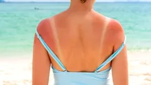 O singură arsură solară intensă îți poate schimba sănătatea pentru totdeauna