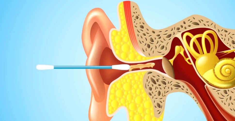 Iată de ce NU ar trebui să foloseşti bastonaşele de vată pentru a-ţi curăţa urechile – FOTO+VIDEO