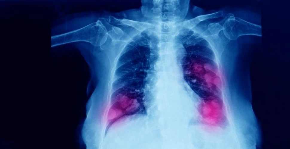 Leziuni pulmonare „ciudate și neașteptate”, descoperite în urma autopsiilor pacienților decedați de COVID-19