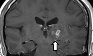 Caz extrem de rar. Un bărbat a stat cu un vierme în creier timp de 4 ani (FOTO)
