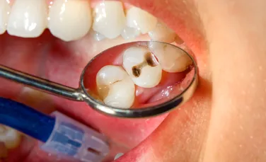 Mai bine de jumătate dintre copii și adulții din România au carii dentare