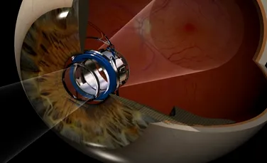 Un telescop minuscul, implantat în ochi, este noua soluţie pentru recăpătarea vederii