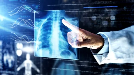 Radiografiile toracice ajută la diagnosticul timpuriu al cancerului pulmonar
