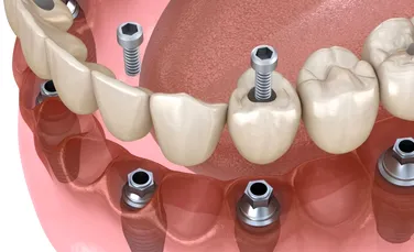 Rolul important pe care îl au suprafețele implantului dentar în fixarea țesuturilor, evitând bacteriile nedorite