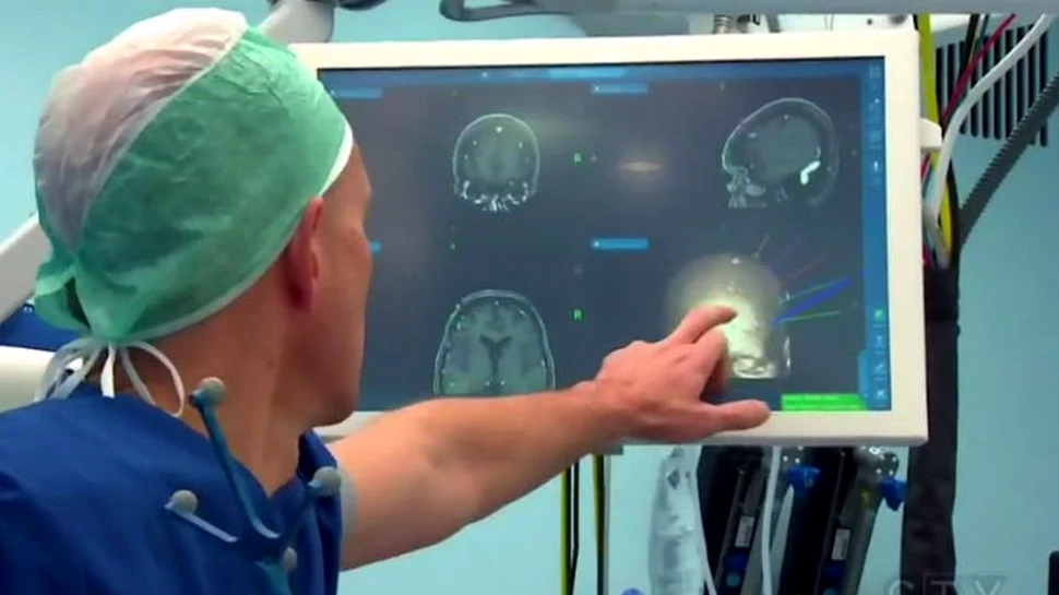 Primul IMPLANT în creier din lume. Astfel s-a creat şi un sistem de citire a gândurilor
