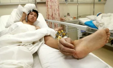 Operaţie incredibilă: medicii chinezi au ataşat braţul retezat al unui pacient la glezna acestuia (FOTO)