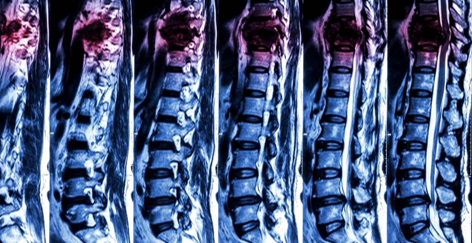Veste bună pentru pacienţii cu leziuni la coloana vertebrală. Efectele leziunii, precum paralizia sau dificultatea de respirare, pot fi reversibile
