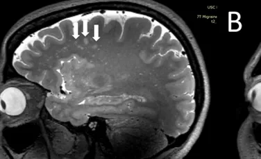 Un studiu fără precedent dezvăluie cum arată migrenele în creier