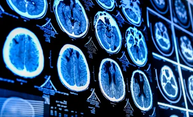 Un tratament experimental a redus la jumătate o tumoare cerebrală
