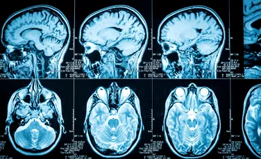 Scanerele cerebrale ultra-puternice i-ar putea ajuta pe cei cu Parkinson. Iată cum!