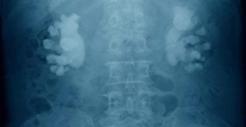 Un robot a extirpat o tumoră renală din corpul unei fetițe de 4 ani