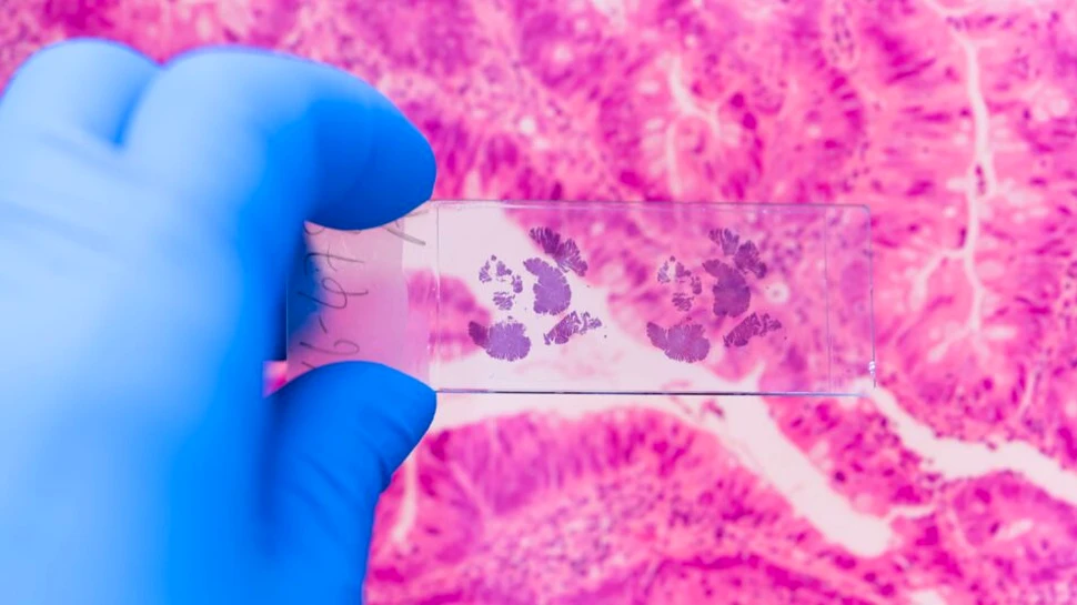 Cercetătorii canadieni anunță o descoperire majoră în lupta împotriva cancerului