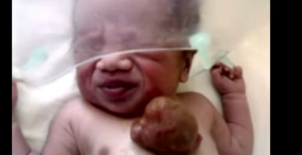 Caz foarte rar în România: un copil născut cu inima în afara corpului a fost dus în Italia pentru operaţie (VIDEO)