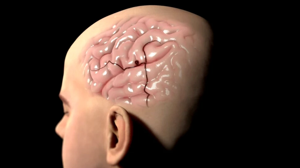 Oamenii au un risc de 3% să facă un anevrism cerebral de care nu vor afla niciodată