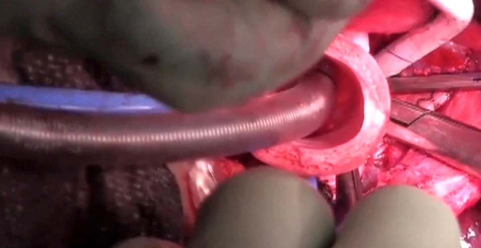 Pentru prima dată în istorie a fost efectuat transplantul unui organ sintetic (VIDEO)
