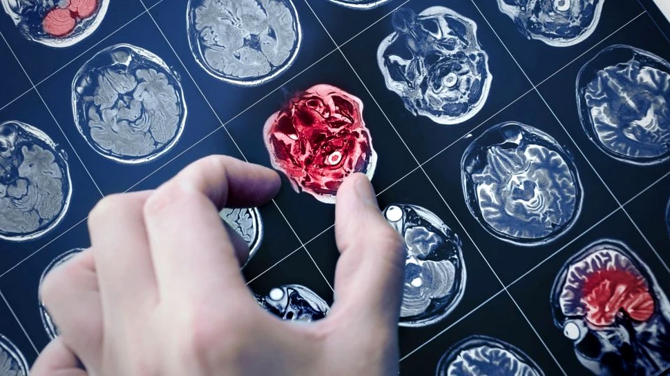 O femeie a reuşit cu ajutorul unei mutaţii genetice să îşi depăşească riscul de a dezvolta Alzheimer