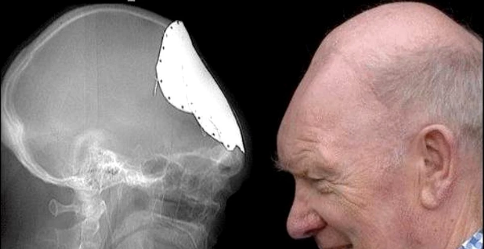 Dupa zeci de ani, unui barbat i se dezvolta un nou craniu