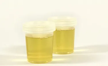 Organismul unei femei din SUA produce singur alcool prin urină. Este primul caz documentat