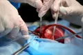 Două inimi de porc, transplantate cu succes la pacienți umani aflați în moarte cerebrală