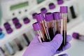 FT: Un studiu dezvăluie grupa de sânge cu risc mai redus de infectare cu noul coronavirus
