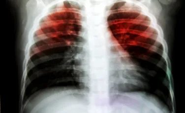 Un test ar putea identifica milioane de oameni care răspândesc tuberculoza fără să știe