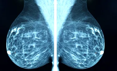 O proteină obscură, responsabilă pentru accelerarea cancerului la sân