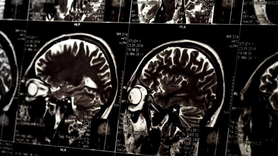 Au fost indentificate zonele din creier care ne ajută să ne amintim cuvinte