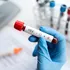 Infecția cu HIV lasă în urmă o „memorie imunologică” în celule