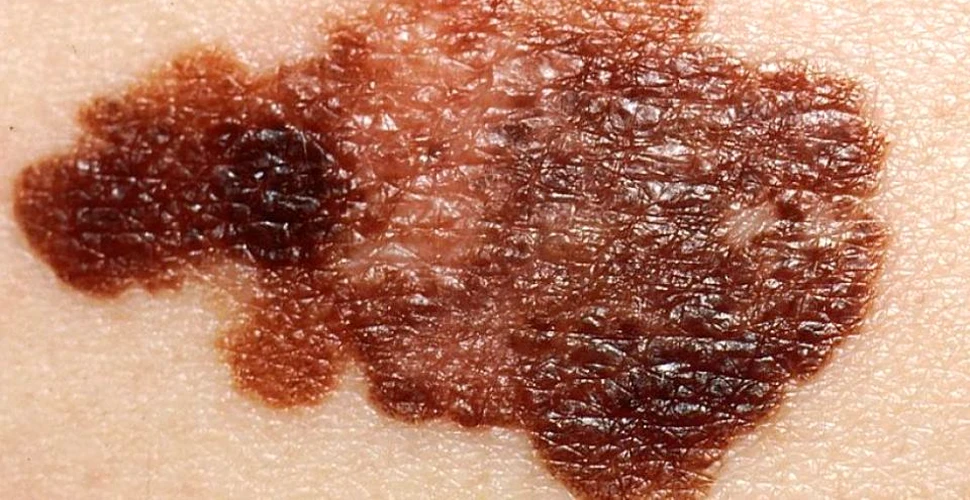 S-au descoperit două forme de melanom care nu sunt asociate cu cancerul de piele şi cu expunerea la soare