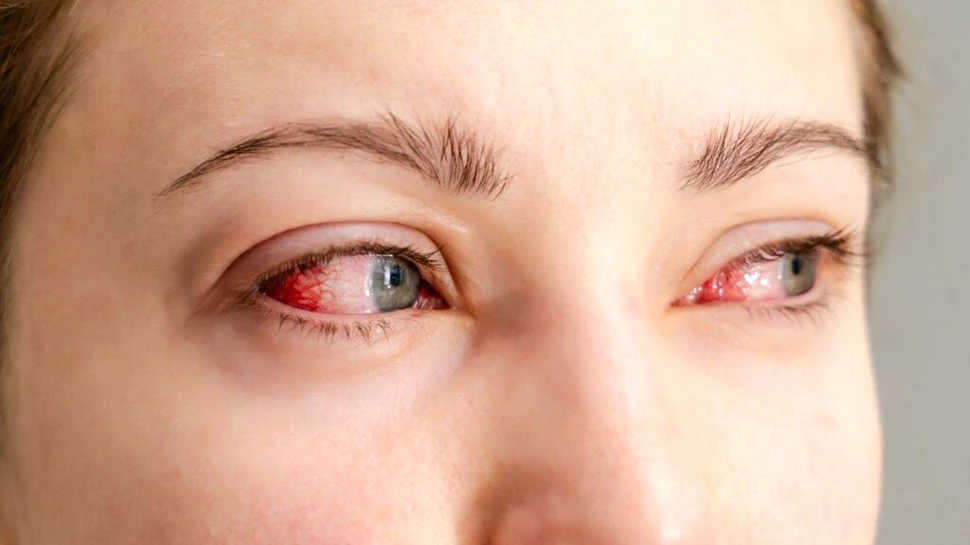 „Ochiul roșu”: Când o simplă iritație ascunde o infecție și de ce automedicația este riscantă (P)