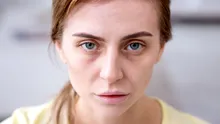 „Ferritin face”, noul termen viral de pe rețelele sociale. Ce legătură are cu deficitul de fier